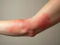 Ramię z zaczerwienioną, swędzącą wysypką alergiczną, która wygląda jak drobne, czerwone kropki i plamy.