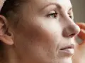 Zbliżenie na twarz kobiety z widocznym rogowaceniem i bliznami po trądziku. W tle ręcznik na głowie.