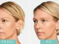 Radiesse czy kwas hialuronowy - porównanie skuteczności i zastosowania
