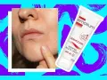 Suchy naskórek wokół ust. Krem Emolium Dermocare na wiatr i mróz SPF 20. Emolienty co to? To ratunek dla suchej skóry.