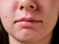 Suchy naskórek wokół ust i nosa, z widocznymi zaczerwienieniami i łuszczącymi się fragmentami skóry.