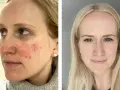 Przed i po: zaczerwieniona skóra z wypryskami vs. gładka cera. Soolantra opinie potwierdzają skuteczność.