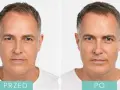 Ile to jest 1 ml kwasu hialuronowego i jak wpływa na efekty zabiegów?