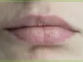 Zbliżenie na usta z widocznymi pęknięciami i suchą skórką. Suche usta potrzebują nawilżenia.