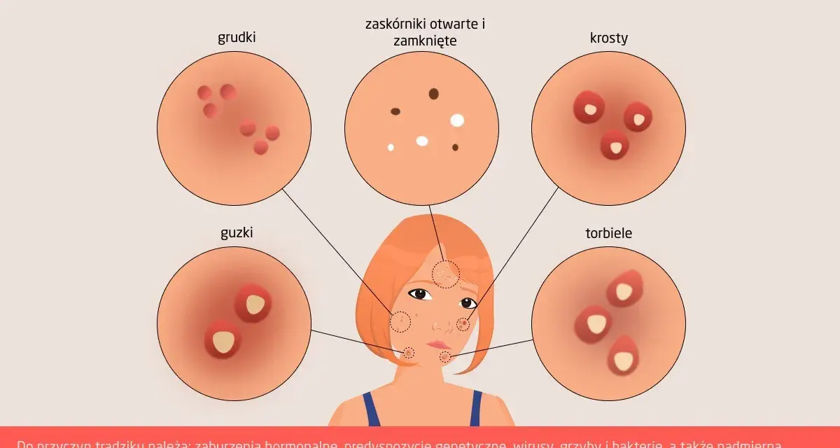 Ilustracja pokazuje różne rodzaje trądziku: grudki, guzki, zaskórniki, krosty i torbiele. Każdy pryszcz ma swój opis.