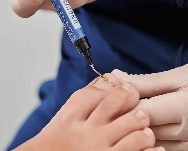 Jak zerwać paznokieć bez bólu? Skuteczne metody i porady