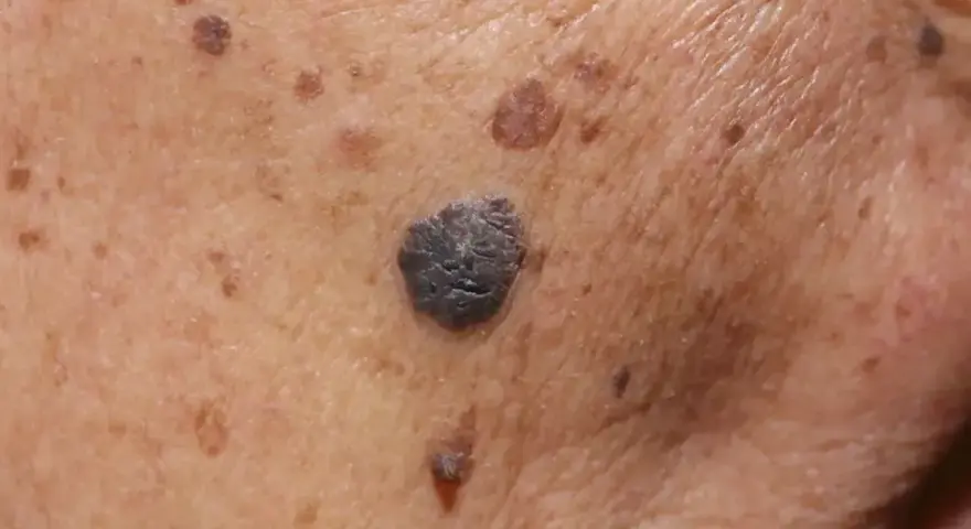 Zbliżenie na skórę z licznymi, ciemnymi, suchymi plamami i przebarwieniami. Widoczna jedna większa, ciemna zmiana.