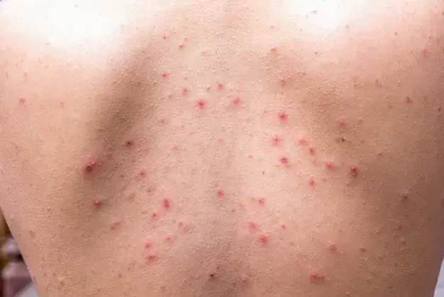 Skuteczne sposoby na pryszcze na plecach – jak się pozbyć problemu
