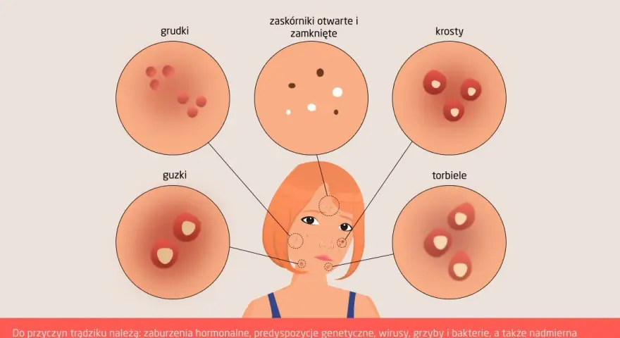Ilustracja pokazuje różne rodzaje trądziku: grudki, guzki, zaskórniki, krosty i torbiele. Każdy pryszcz ma swój opis.