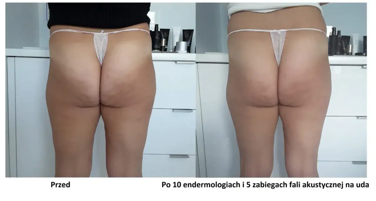 Przed i po zabiegu na cellulit: widoczna poprawa skóry ud po endermologii i fali akustycznej.